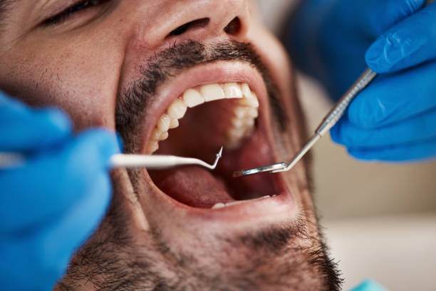 Best Emergency Wisdom Teeth Removal in Bowling Green, VA