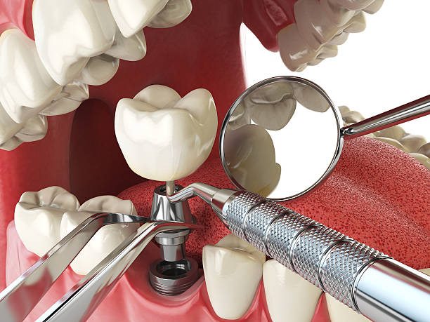 Best Urgent Care for Lost Fillings or Crowns in Bowling Green, VA