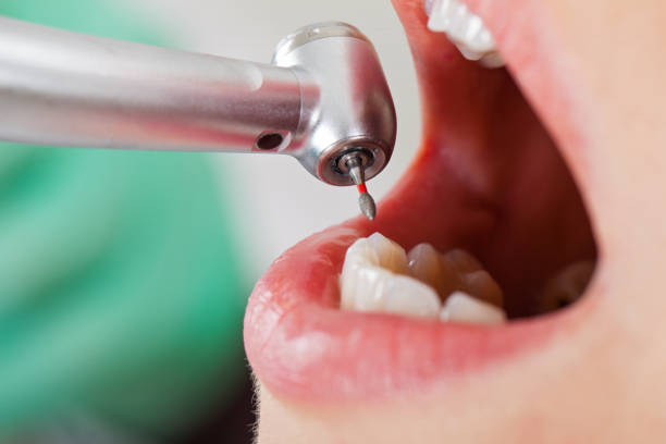 Best Emergency Tooth Extraction in Bowling Green, VA
